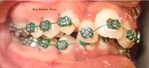 Dental Brace