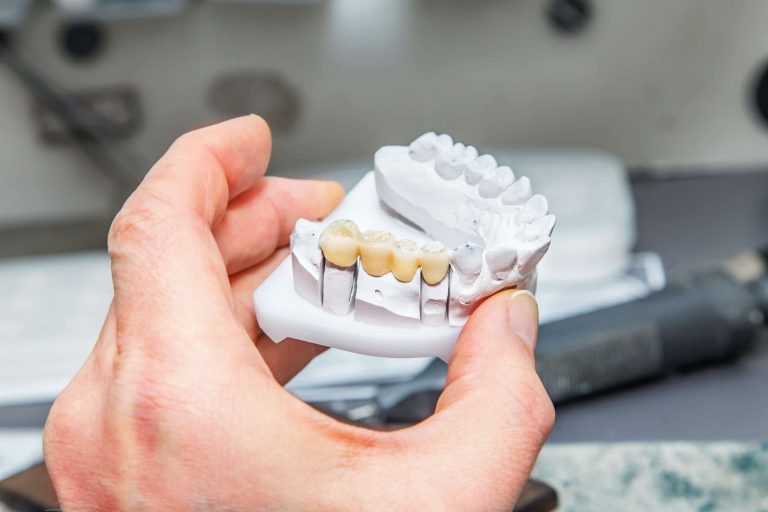 dental crown and bridge