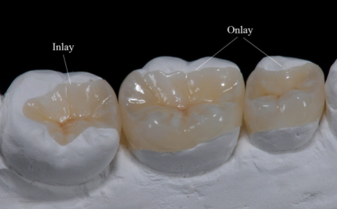 Inlay filling