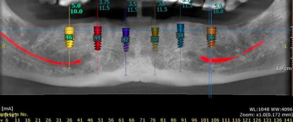 dental Implant