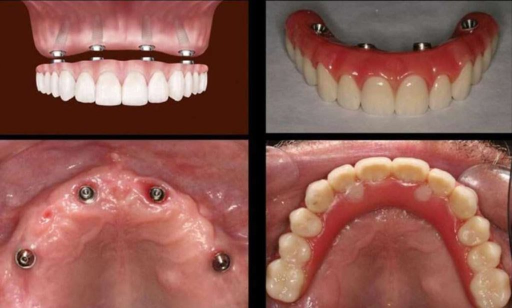 All on four dental implant