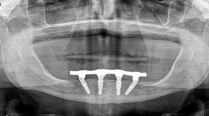 All On 4 Dental Implant Braces And Dental Care With Dr Rahman 