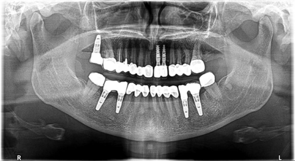 dental implant