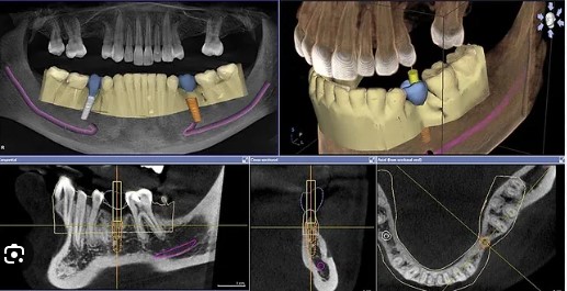 Guided dental Implant