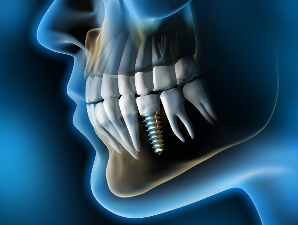 Best Dental Implant in Dhaka