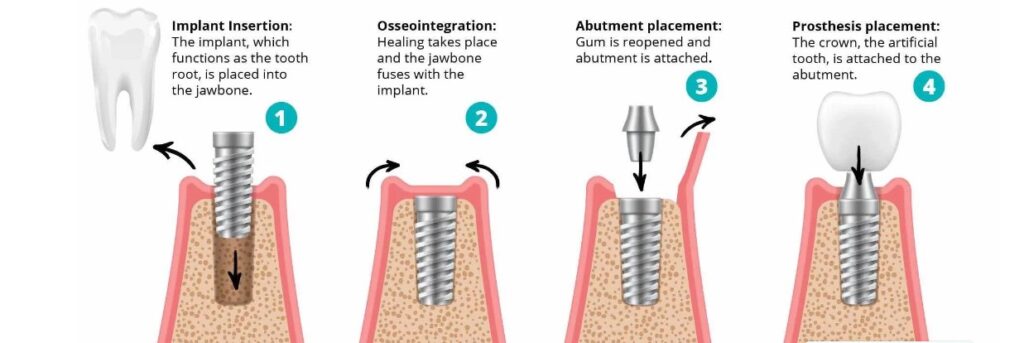 best-dental-implant-in-dhaka