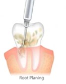 root planing