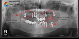 Best Dental Implant in Dhaka