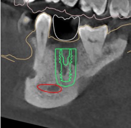 Dental Implant, Banani, Dhaka