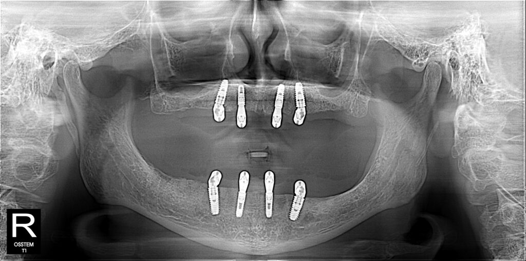 All on 4 dental Implant