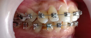 Dental Brace in Dhaka
